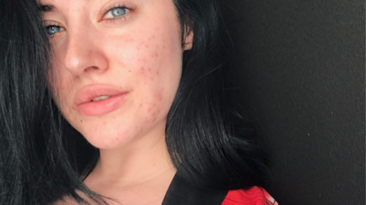 How Fashion Is Embracing The Pimple Positivity Movement We Desperately Need Model Starlie 8029