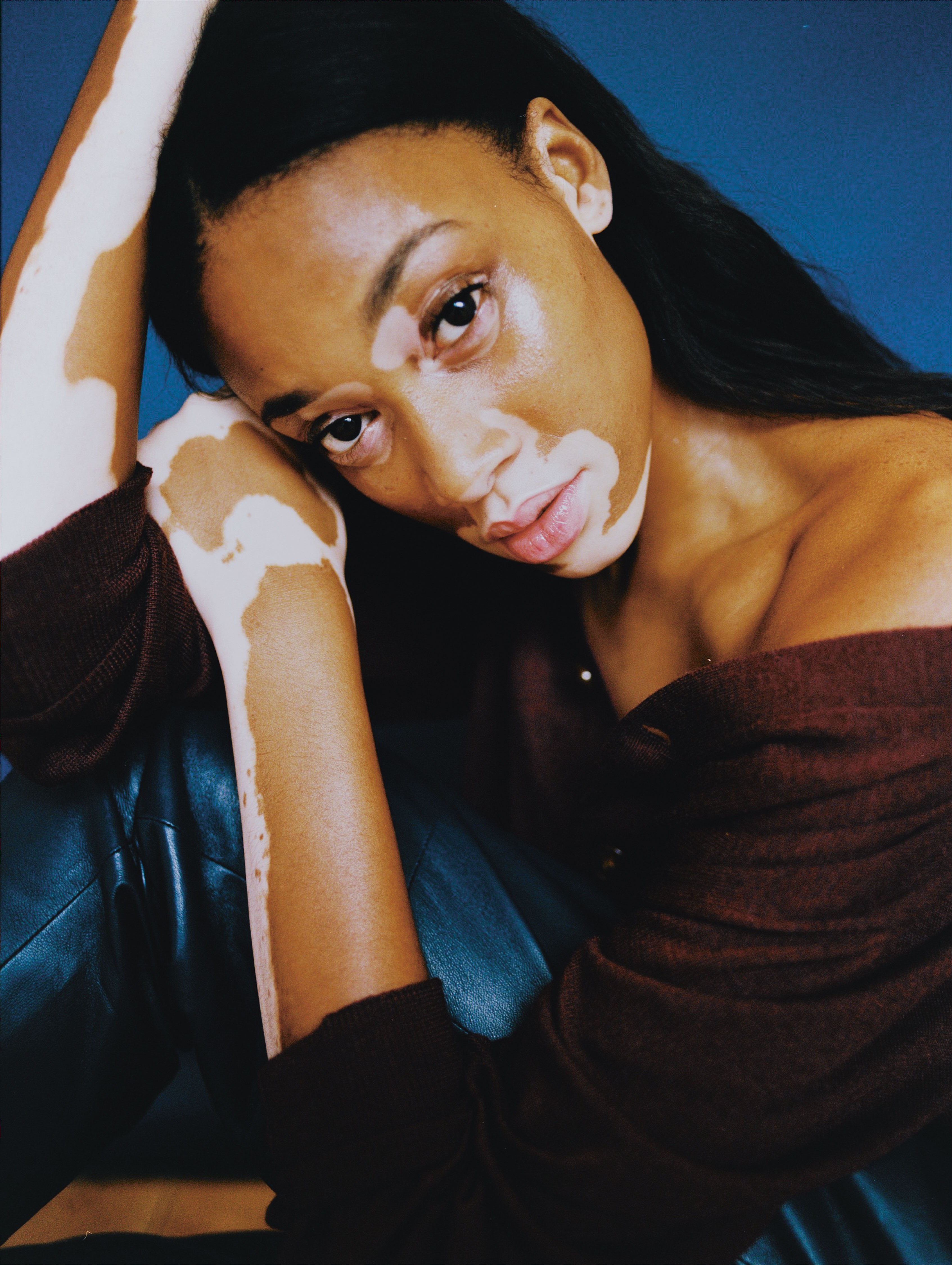 chantelle winnie proves that what makes you different makes you beautiful